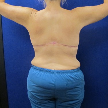 Patient After Arm Lift Surgery
