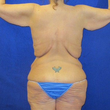 Patient Before Arm Lift Surgery