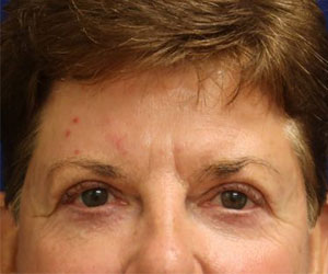 Patient After Blepharoplasty Surgery