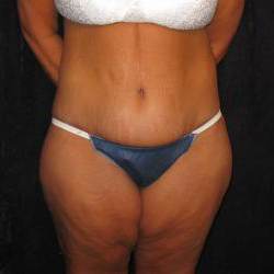 Patient After Body Contouring Surgery