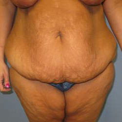 Patient Before Body Contouring Surgery