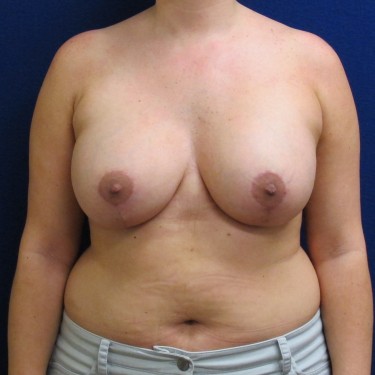 Patient After Breast Lift Surgery