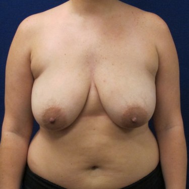 Patient Before Breast Lift Surgery