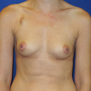 Patient Before Breast Reconstruction Surgery