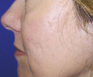 Patient After Fraxel Dual Laser Treatment