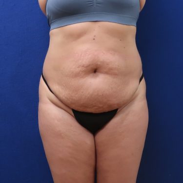 Patient Before HiDef Liposuction