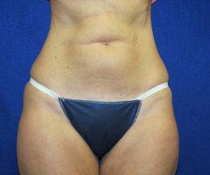 Patient Before Liposonix Surgery