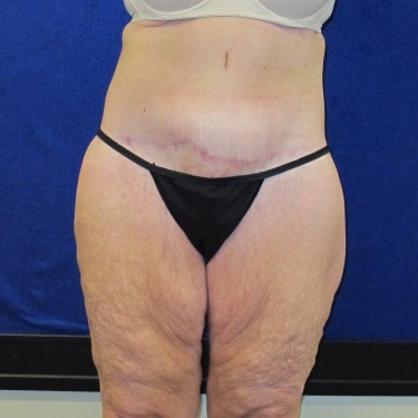 Patient After Lower Body Lift Surgery