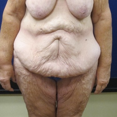 Patient Before Lower Body Lift Surgery