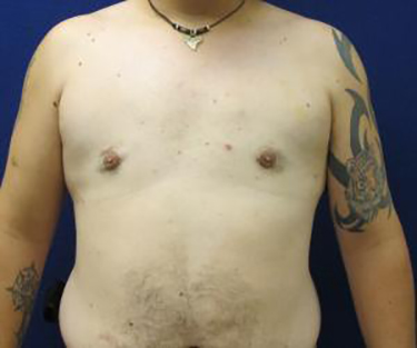 Patient After Male Breast Reduction Surgery