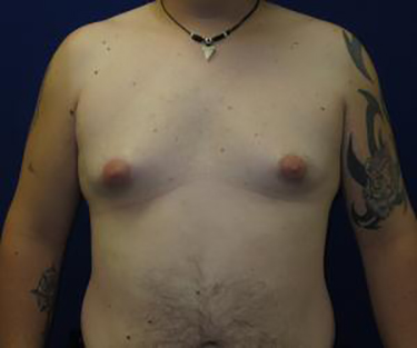 Patient Before Male Breast Reduction Surgery