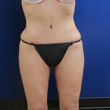 Patient After Thigh Lift Surgery