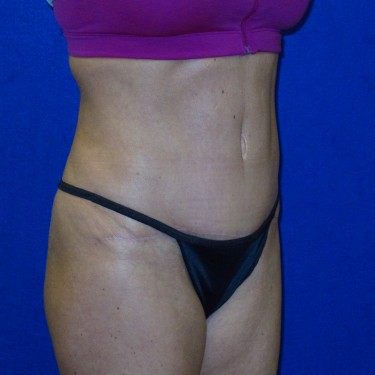 Patient After Tummy Tuck Surgery