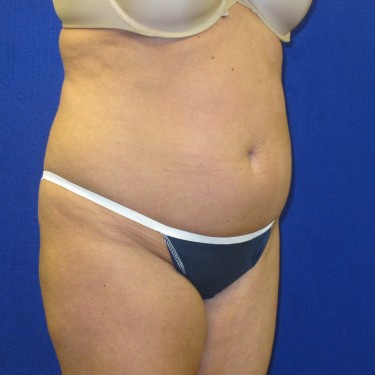 Patient Before Tummy Tuck Surgery