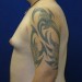 PATIENT 67 Before - 2