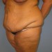 PATIENT 94 Before - 2