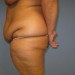 PATIENT 94 Before - 3
