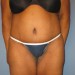 PATIENT 95 After