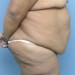 PATIENT 95 Before - 2