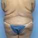 PATIENT 95 Before - 3