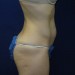 PATIENT 102 Before - 2