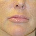 PATIENT 43 After