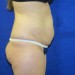 PATIENT 97 Before - 3