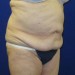 PATIENT 98 Before - 2