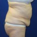 PATIENT 98 Before - 3