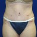 PATIENT 104 After