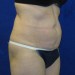 PATIENT 104 Before - 3