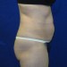 PATIENT 104 Before - 2