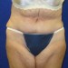 PATIENT 105 After