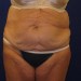 PATIENT 105 Before