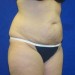 PATIENT 97 Before - 2