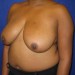 PATIENT 113 Before - 2