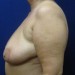 PATIENT 01 Before - 3