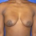 PATIENT 24 Before