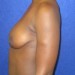 PATIENT 24 Before - 3