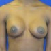 PATIENT 24 After