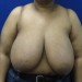 PATIENT 10 Before