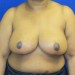 PATIENT 10 After