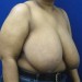 PATIENT 10 Before - 2