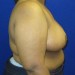 PATIENT 10 After - 3