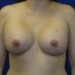 PATIENT 31 After