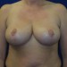 PATIENT 12 After