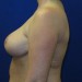 PATIENT 12 After - 3