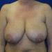PATIENT 12 Before