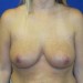 PATIENT 15 After