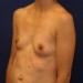 PATIENT 037 Before - 2